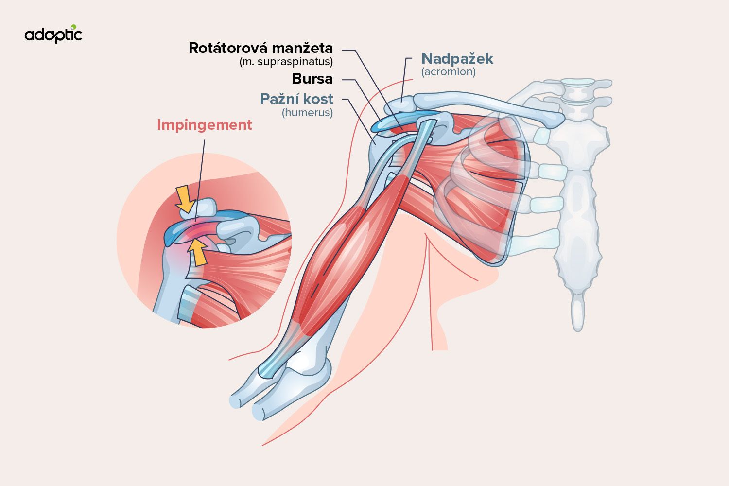 impingement-syndrom-vizualizace.jpg